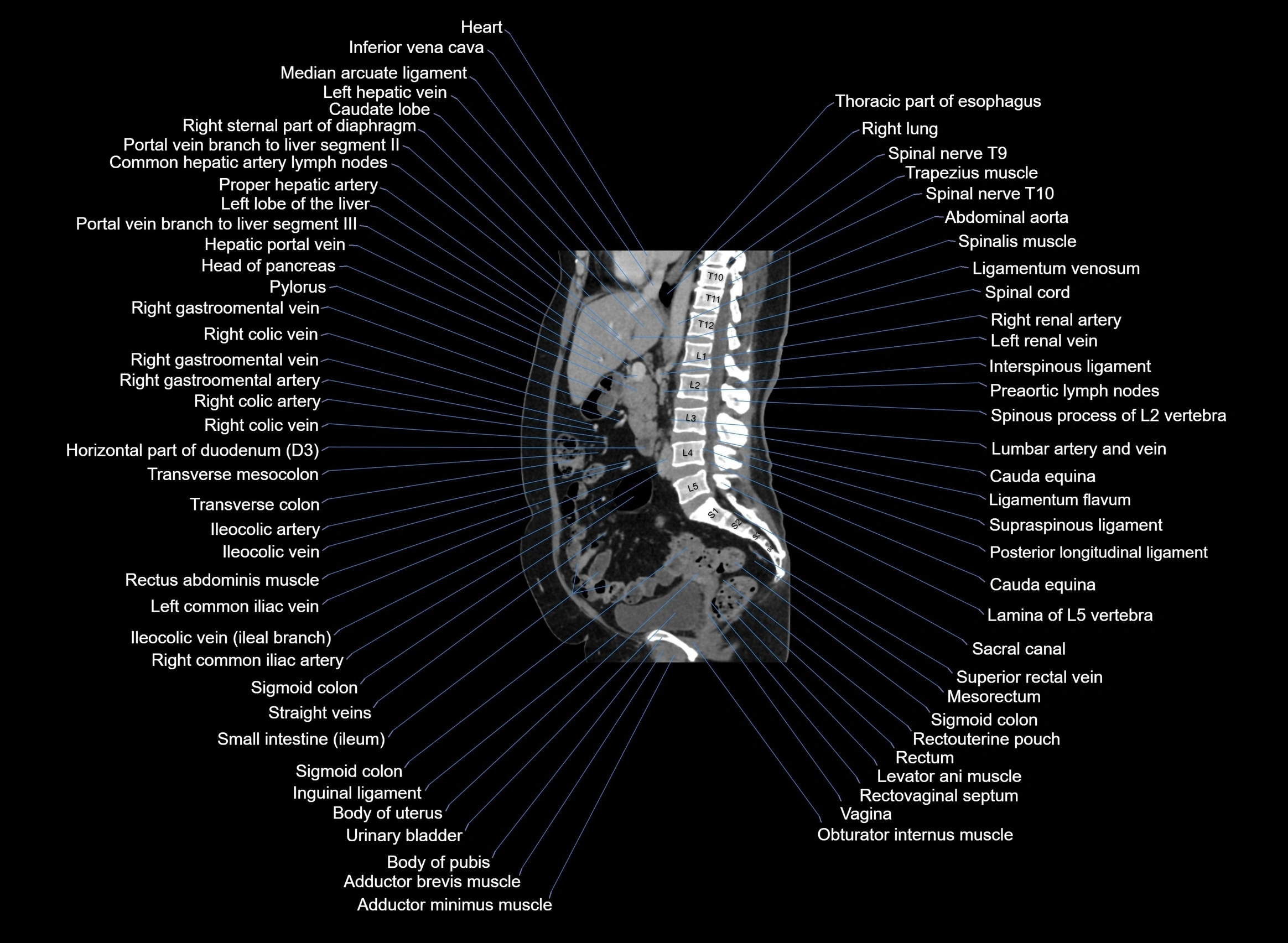 CT Abdomen sagittal cross sectional anatomy labelled radiology image -00062.webp